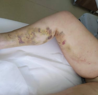 a person with a bruised leg and a wound on their arm