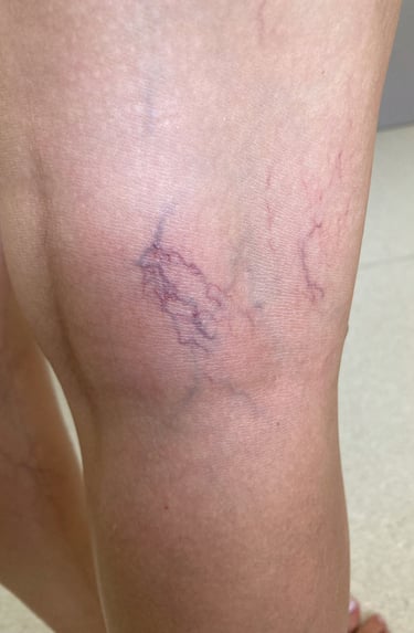 a woman with a vein on her leg